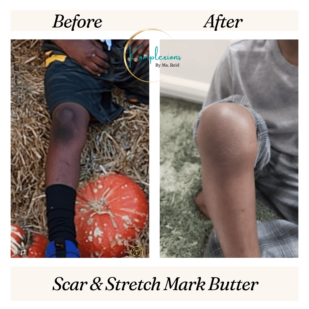 Kreid Skincare and more LLC Scar & Stretch Mark Butter